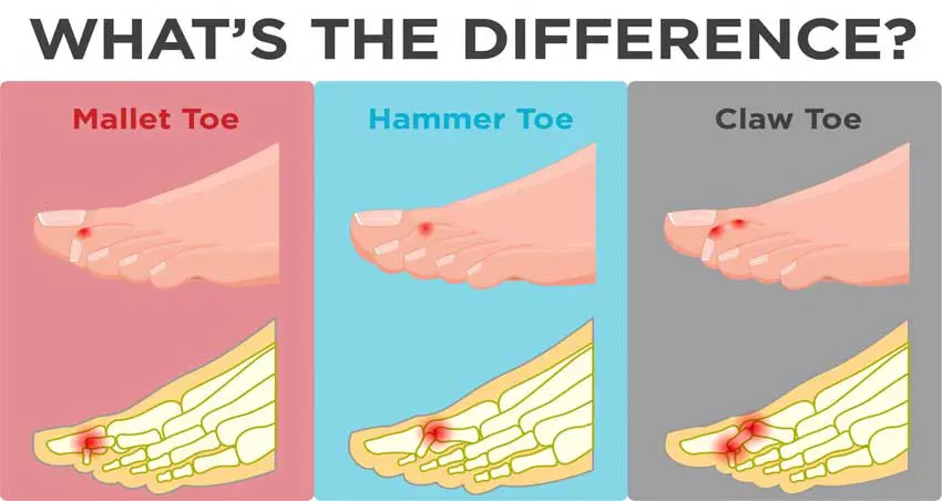 image of different toe deformities