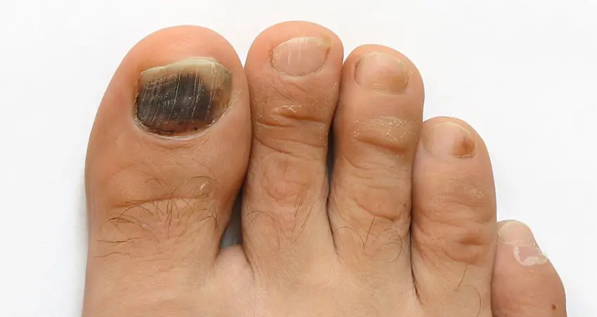 image of black toenail