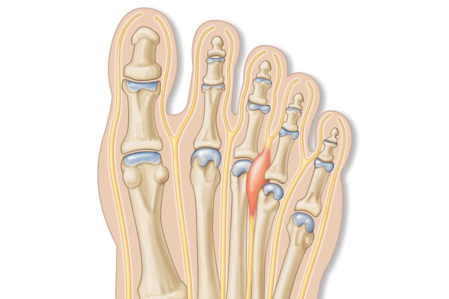 bones of foot showing neuroma