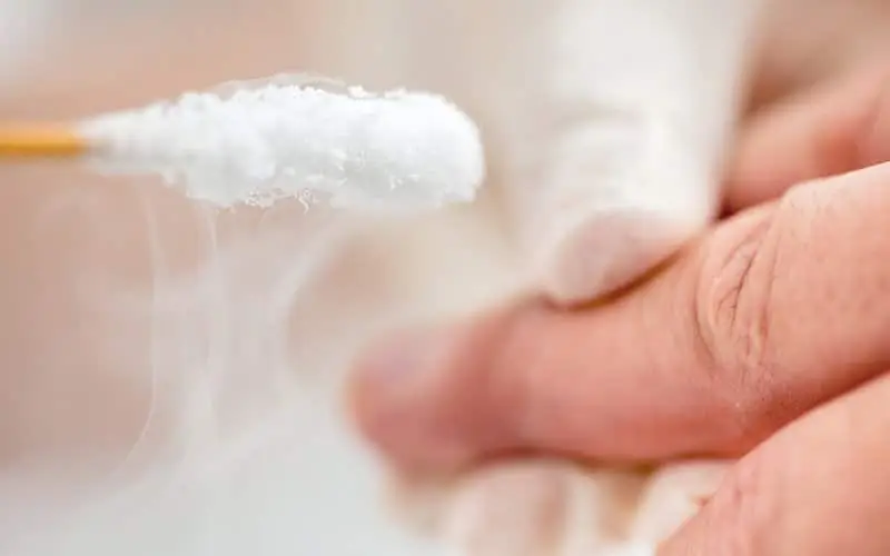 Cryotherapy treatment applying liquid nitrogen to a plantar wart