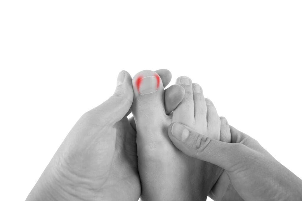 Podiatrist treating an ingrown toenail at a Newcastle clinic