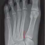 X-ray of a foot showing a Lisfranc injury with a red arrow pointing to a small bone fragment between the first and second metatarsal bases — the classic "fleck sign" of a torn Lisfranc ligament