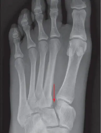 X-ray of a foot showing a Lisfranc injury with a red arrow pointing to a small bone fragment between the first and second metatarsal bases — the classic "fleck sign" of a torn Lisfranc ligament
