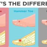 Diagram comparing mallet toe, hammer toe and claw toe — showing the differences in joint position and where pressure points develop