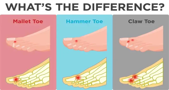 Diagram comparing mallet toe, hammer toe and claw toe — showing the differences in joint position and where pressure points develop