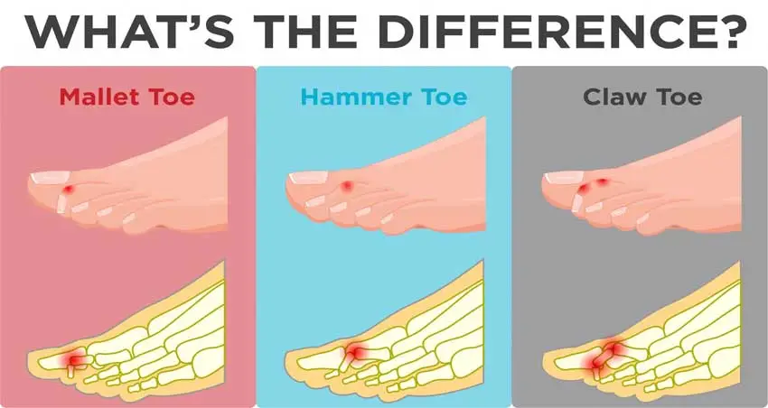 Diagram comparing mallet toe, hammer toe and claw toe — showing the differences in joint position and where pressure points develop