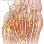 Anatomical illustration of a Morton's neuroma showing the swollen, thickened nerve between the third and fourth metatarsal heads in the forefoot