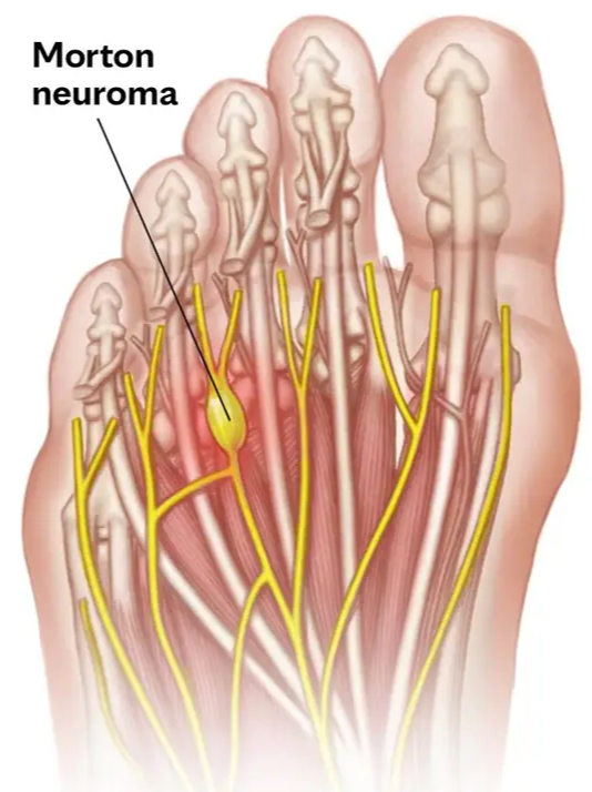 Anatomical illustration of a Morton's neuroma showing the swollen, thickened nerve between the third and fourth metatarsal heads in the forefoot