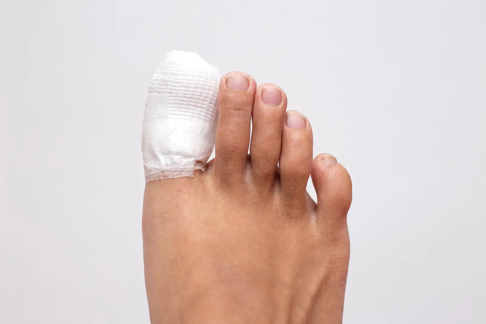 Toe healing well after partial nail avulsion procedure