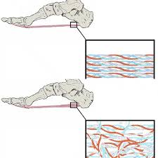 Diagram comparing healthy plantar fascia with aligned collagen fibres above, and degenerated plantar fascia with disorganised, scarred collagen fibres below