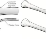 Anatomical diagram of the plantar plate showing collateral ligaments, flexor tendons and plantar fascia, with a comparison of a healthy plantar plate and an elongated, torn plantar plate at the metatarsophalangeal joint.