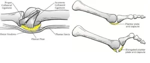 Anatomical diagram of the plantar plate showing collateral ligaments, flexor tendons and plantar fascia, with a comparison of a healthy plantar plate and an elongated, torn plantar plate at the metatarsophalangeal joint.