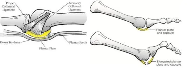 Plantar plate anatomy and elongated plantar plate tear at the second MTPJ Anatomical diagram of the plantar plate showing collateral ligaments, flexor tendons and plantar fascia, with a comparison of a healthy plantar plate and an elongated, torn plantar plate at the metatarsophalangeal joint.