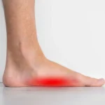 Side view of a flat foot showing a collapsed medial arch with pain highlighted in red along the inner arch — the typical appearance of posterior tibial tendon dysfunction (PTTD)