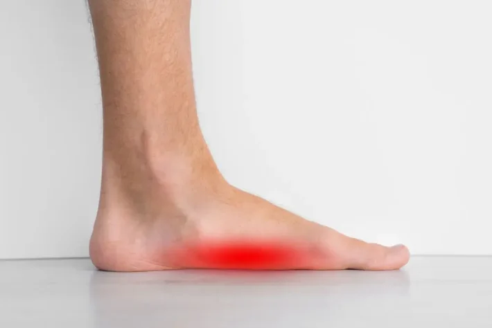 Side view of a flat foot showing a collapsed medial arch with pain highlighted in red along the inner arch — the typical appearance of posterior tibial tendon dysfunction (PTTD)