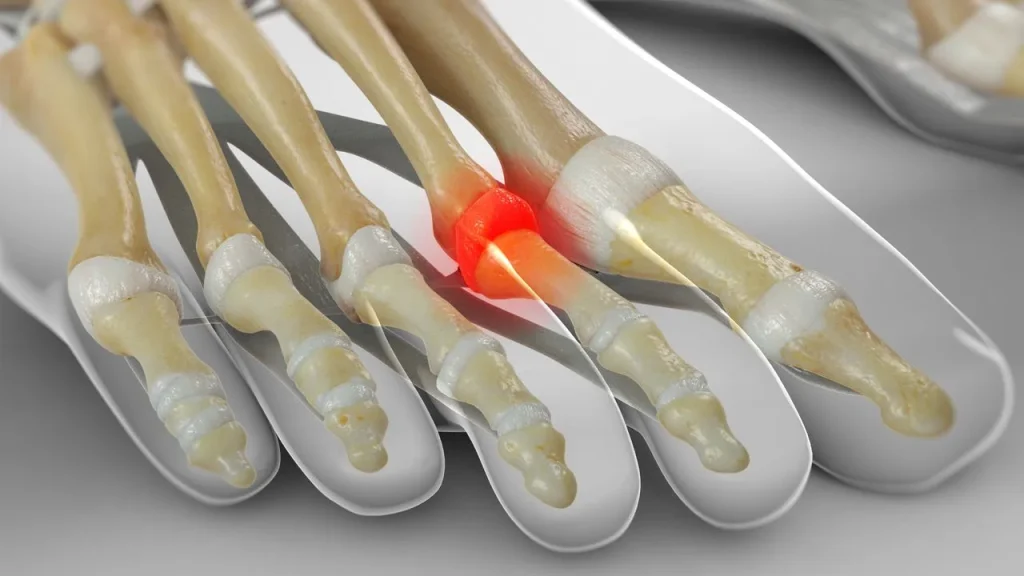 3D anatomical illustration of a foot showing inflammation at the second metatarsophalangeal joint (MTPJ), highlighted in red — the classic location of MTPJ synovitis and ball-of-foot pain