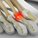 3D anatomical illustration of a foot showing inflammation at the second metatarsophalangeal joint (MTPJ), highlighted in red — the classic location of MTPJ synovitis and ball-of-foot pain