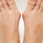 Anatomical diagram of a bunion (hallux valgus) showing the first metatarsal deviating outward and the big toe angling toward the second toe, with the bunion prominence at the first metatarsophalangeal joint
