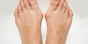 Anatomical diagram of a bunion (hallux valgus) showing the first metatarsal deviating outward and the big toe angling toward the second toe, with the bunion prominence at the first metatarsophalangeal joint