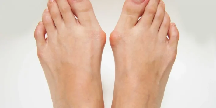 Anatomical diagram of a bunion (hallux valgus) showing the first metatarsal deviating outward and the big toe angling toward the second toe, with the bunion prominence at the first metatarsophalangeal joint