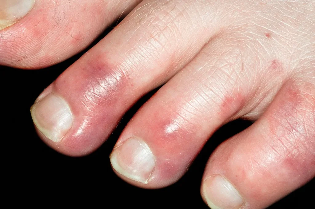 Toes affected by chilblains showing the typical red and purple discolouration and swelling that appears in cold winter weather