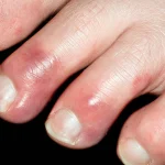 Toes affected by chilblains showing the typical red and purple discolouration and swelling that appears in cold winter weather