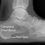 Side-on X-ray of a heel showing a calcaneal heel spur at the underside of the heel bone where the plantar fascia attaches