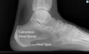 Side-on X-ray of a heel showing a calcaneal heel spur at the underside of the heel bone where the plantar fascia attaches