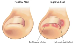 Medical illustration comparing a healthy toenail with an ingrown toenail showing swelling, infection and nail penetrating the flesh
