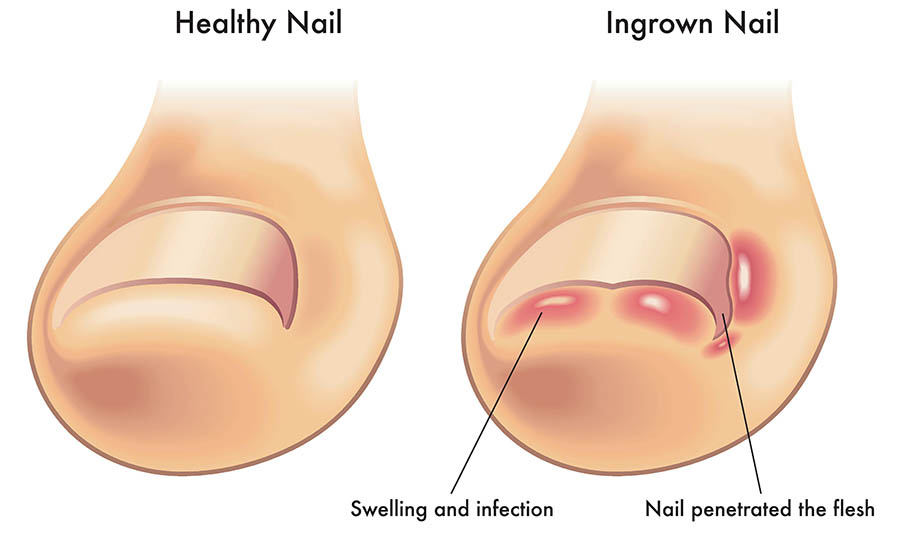 Medical illustration comparing a healthy toenail with an ingrown toenail showing swelling, infection and nail penetrating the flesh