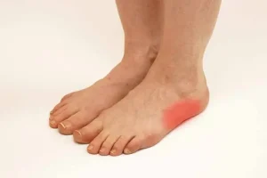 Side view of the foot showing the cuboid bone on the outer midfoot, the site of pain in cuboid syndrome