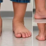 Child standing barefoot showing flexible flat feet, with the arch lowering on standing and reappearing on tiptoe